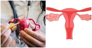 Home remedies for PCOD for women