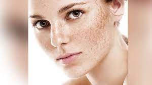Learn the causes of pigmentation and its proper treatment