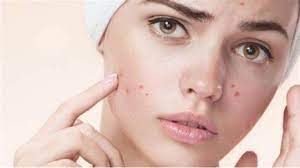 Follow these tips to get rid of pimples problem