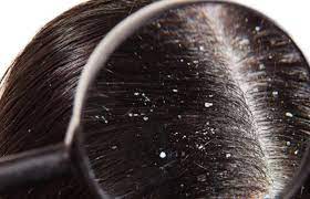 Worried about hair loss and dandruff in winter