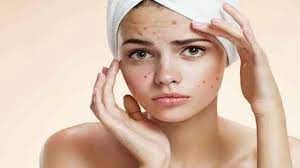 These bad habits are responsible for the problem of pimples on the face