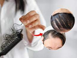 Why does hair fall more in winter Follow these steps to stop hair fall